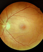 Retinal Scan Image